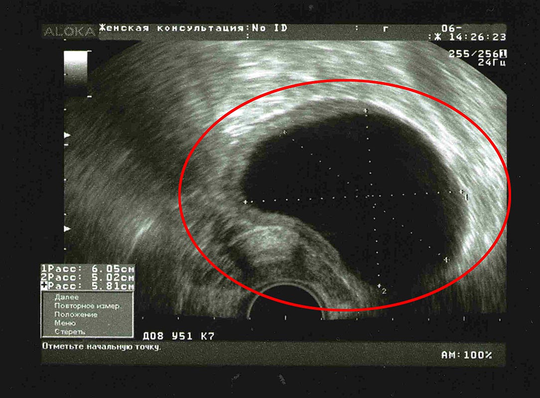 Киста яичника во время беременности