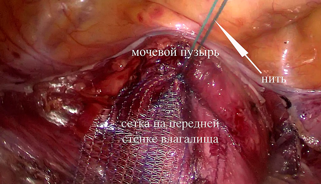 Выпадение и опущение органов малого таза